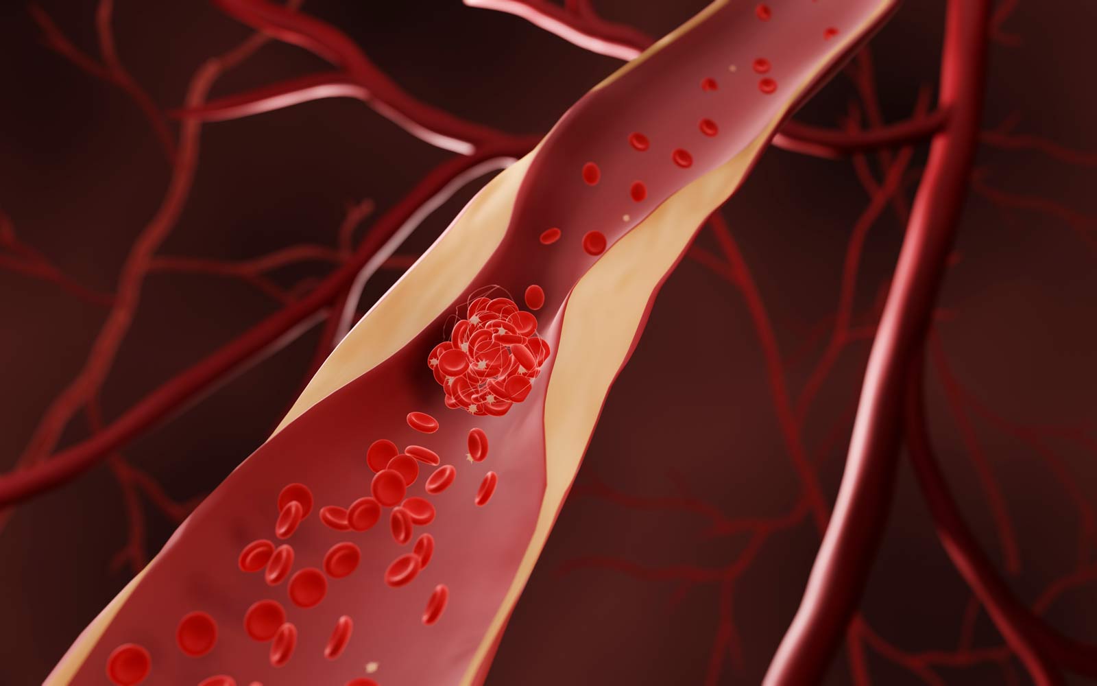 Illustrasjon av en blodpropp som dannes i en blodåre som er innsnevret grunnet åreforkalkning. 