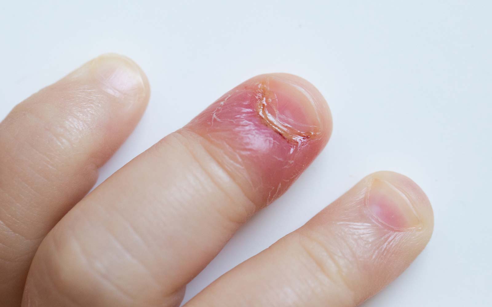 Bildet viser akutt neglerotbetennelse hos et lite barn. Fingeren er rød og betent, og det er pussdannelse i neglefolden.