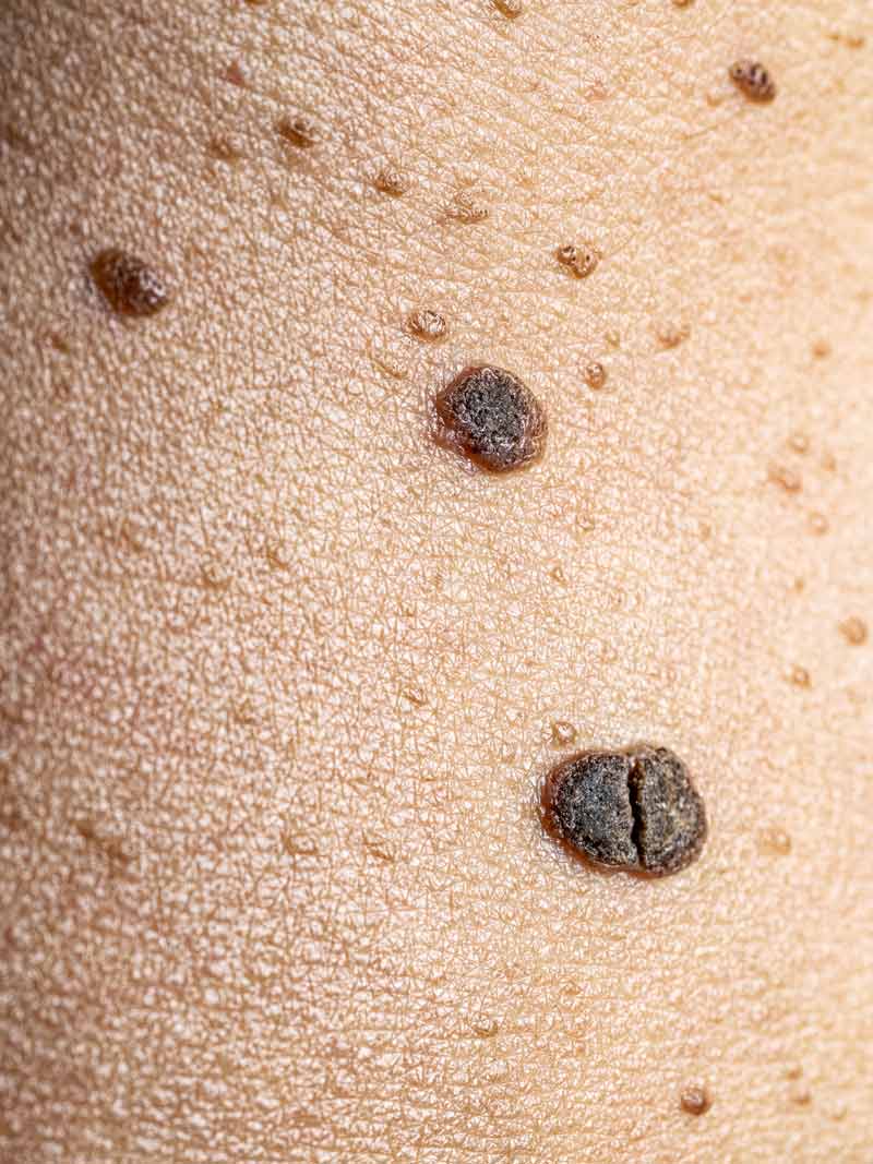 Nærbilde av flere gammelmannsvorter på et hudområde. Utvekstene er mørkebrune på farge.